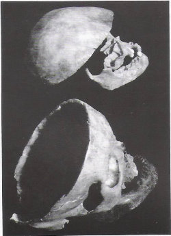 Skulls attributed to Louis XI at the top and to Charlotte de Savoie at the bottom - Histoire de la médecine